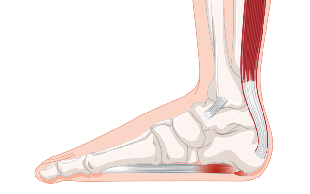 Illustration of a foot showing heel pain area