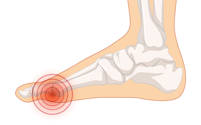 Illustration of a foot showing a bunion deformity